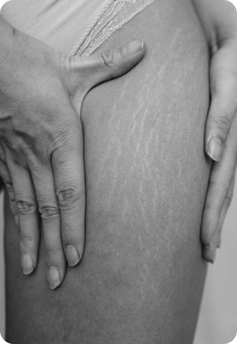 Close-up of a person’s thigh showing natural skin texture and stretch marks, related to Energy Lounger anti-aging benefits.